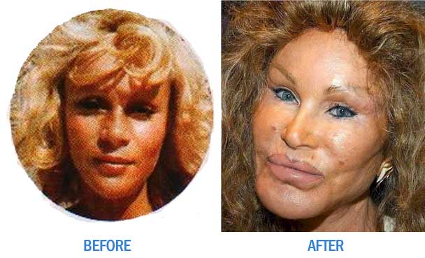 Facelift Before And After. plastic surgery,